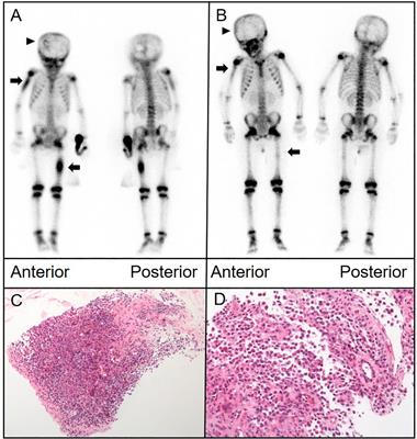 Case report: Exploring the utility of whole-body bone scintigraphy for pediatric Langerhans cell histiocytosis: insights from clinical practice